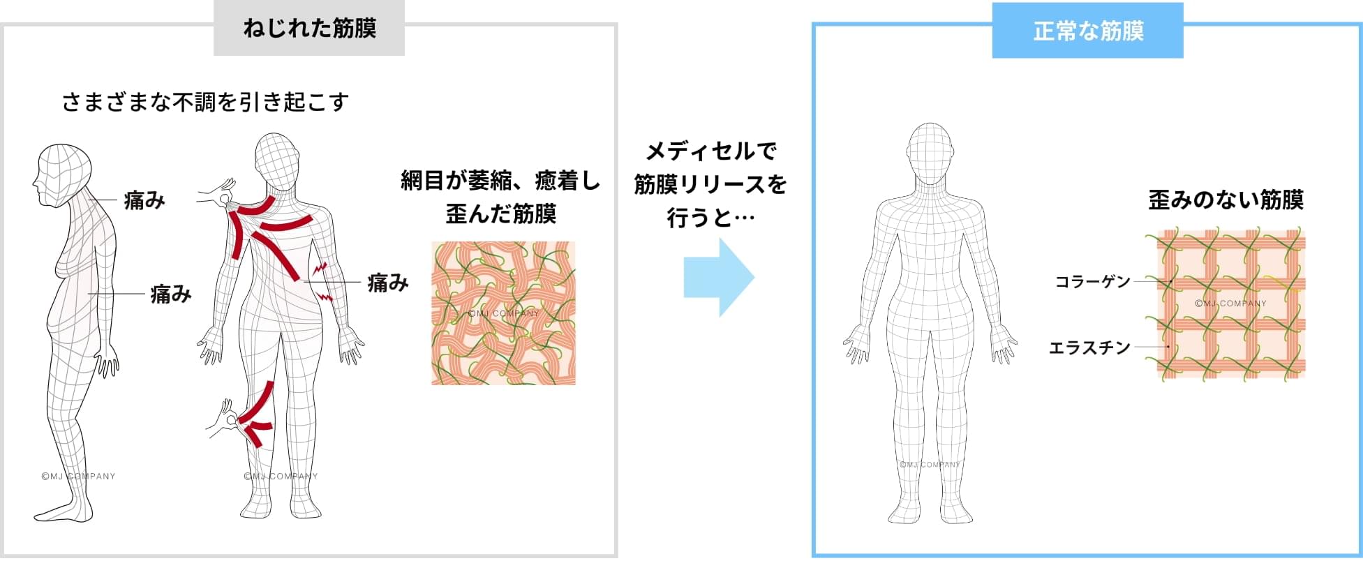 治療について|つむぎ整骨院|全身整体|筋膜リリース(メディセル)|電気治療(フィジオ5D)